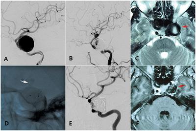 Variation of Mass Effect After Using a Flow Diverter With Adjunctive Coil Embolization for Symptomatic Unruptured Large and Giant Intracranial Aneurysms